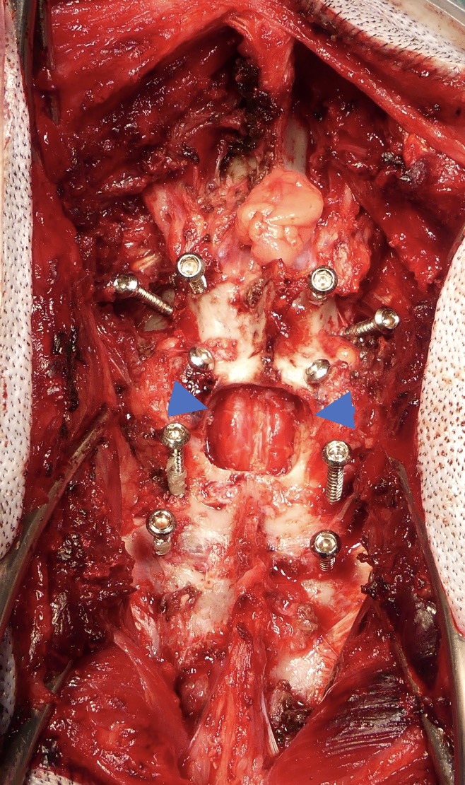 Chirurgie lors d'instabilité lombosacrée